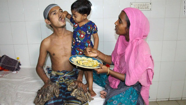 Бангладешлик “дарахт одам” операция қилинади